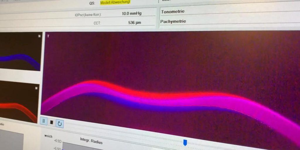 Breakthrough in measuring the success of Cross-Linking for keratoconus