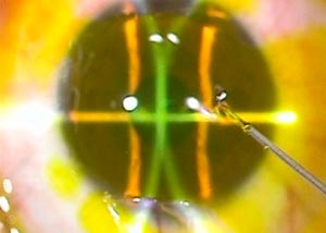 Cross-Linking: Off-label applications. Picture of a cornea that's had a flap cut for LASIK - excimer laser ablation has been performed on the exposed stroma, and now riboflavin has been dropped onto the exposed stroma, ready for cross-linking. As this is meant to be a "normal" cornea, the amount of UV irradiation applied is going to be lower than you would normally perform in CXL for a patient with keratoconus using the Dresden protocol.