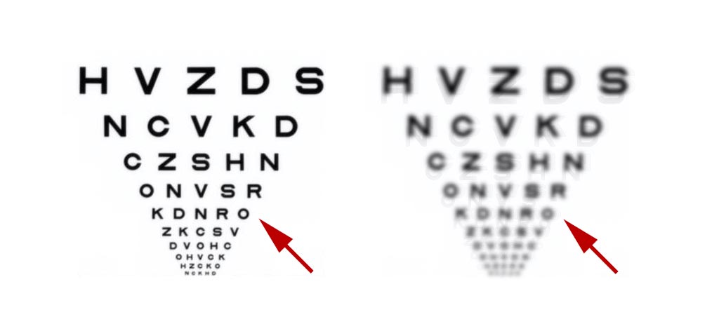 Cross-Linking: Off-label applications. ETDRS chart showing post-CXL vision (blurred, halo) with sclerals, and post-PRK plus sclerals vision. Same visual acuity. Different visual quality. Post PRK vision is way better.