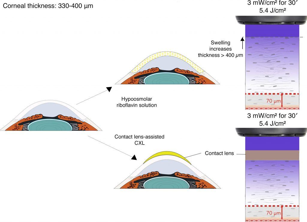 CXL in thin corneas: traditional protocols