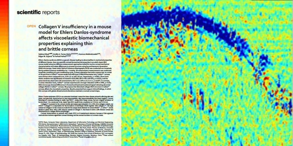 Ehlers-Danlos cornea new insights