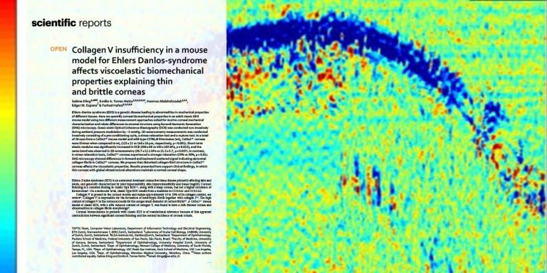 Ehlers-Danlos cornea new insights