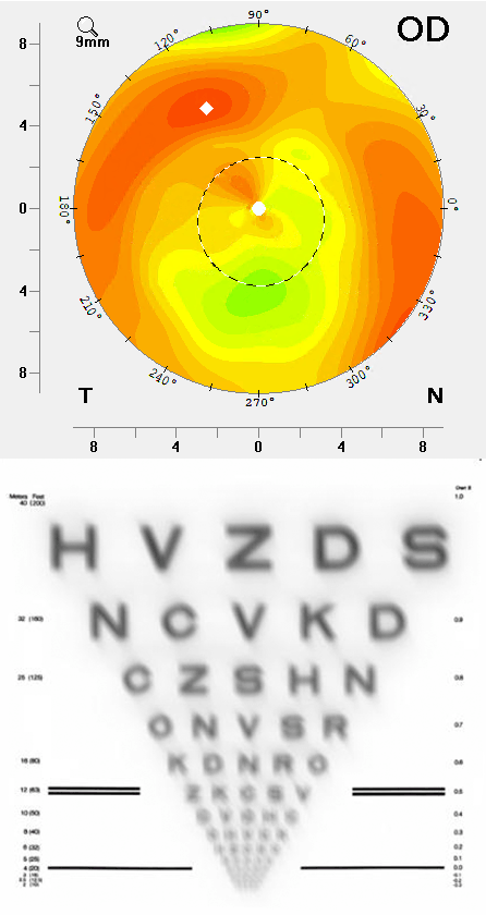 Complications after laser surgery