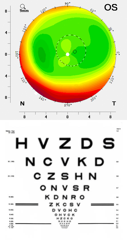 Fix vision after old laser correction