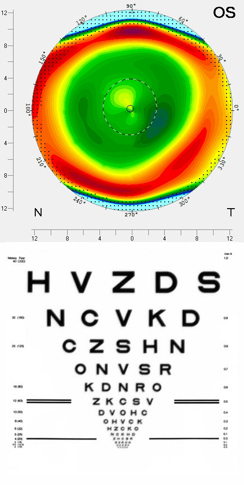 Vision correction after PRK