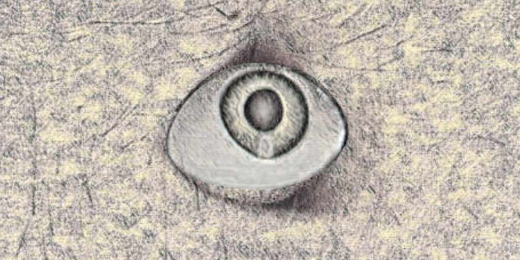 Cataract and bariatric surgery