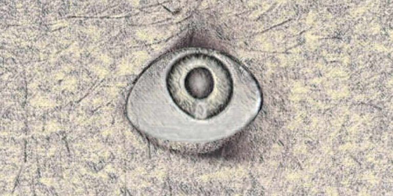 Cataract and bariatric surgery