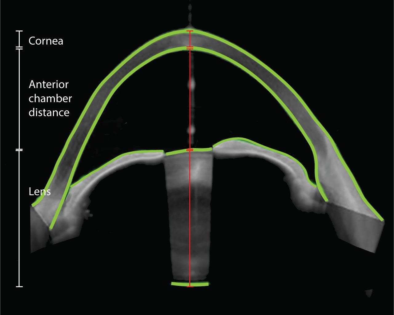 Messungen der Vorderkammertiefe
