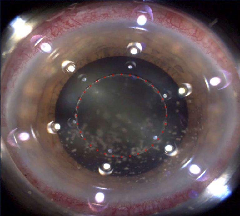 Ein Femtosekundenlaser hat eine Kapsulotomie gemacht