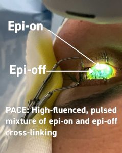 Customized corneal cross-linking with PACE