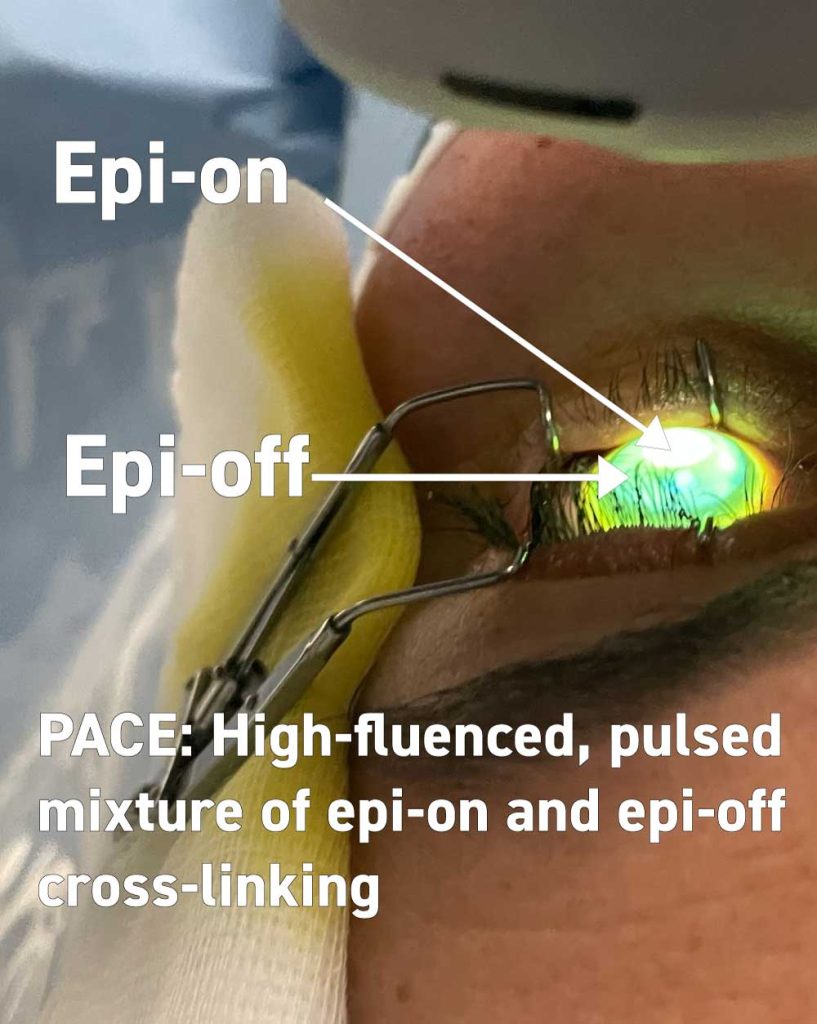 Customized corneal cross-linking with PACE