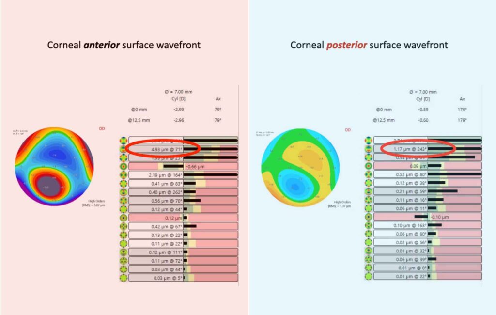 Alt Text: Impact of Posterior Corneal Surface - Visual representation showing how the posterior corneal surface, in conjunction with other internal factors, contributes to high-order aberrations in the eye's optical system