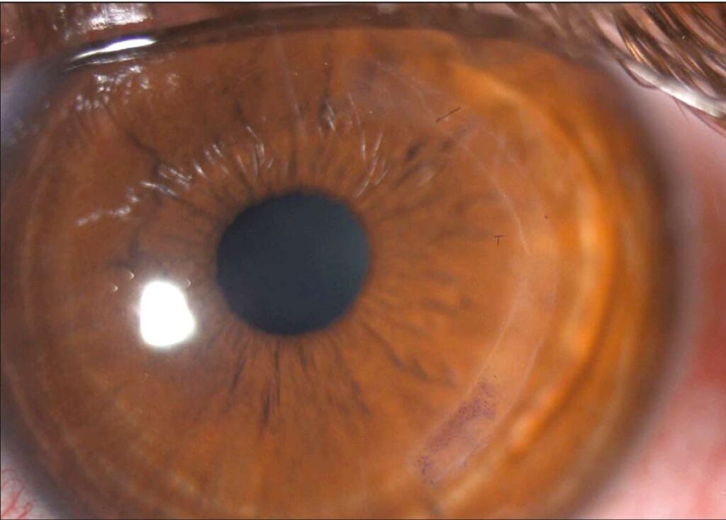 Femto-CAIRS inserted into eye photograph