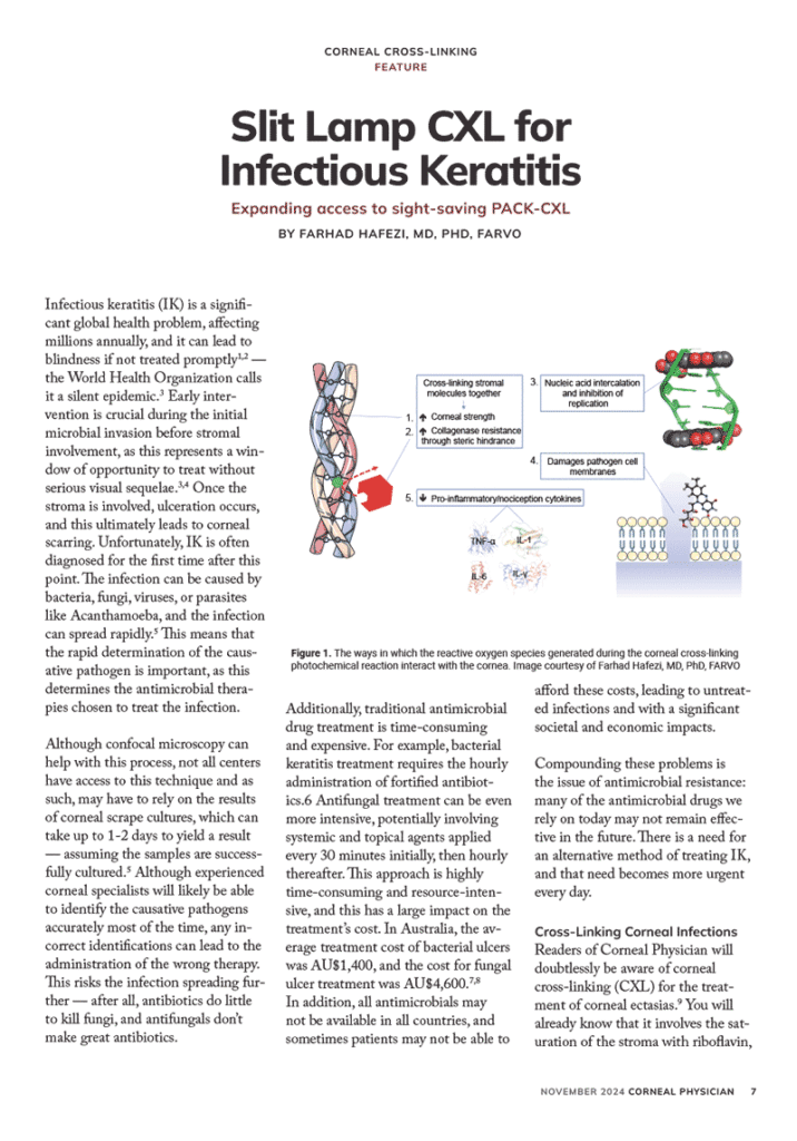 Slit-Lamp-CXL-for-infectious-keratitis-treatment