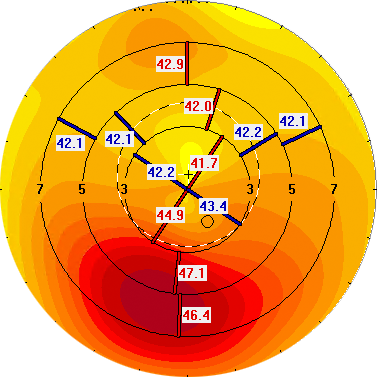 Son with keratoconus