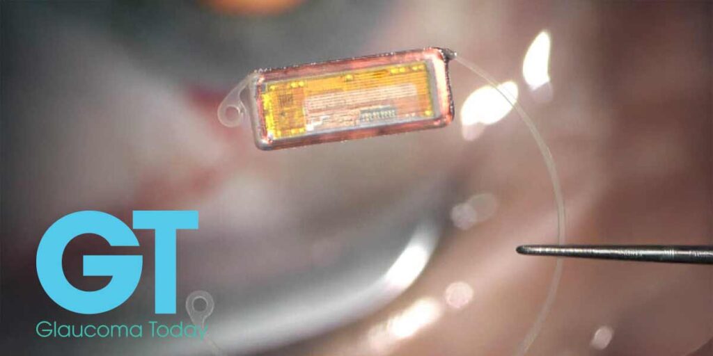 O sistema Eyemate: Transformando o gerenciamento do glaucoma