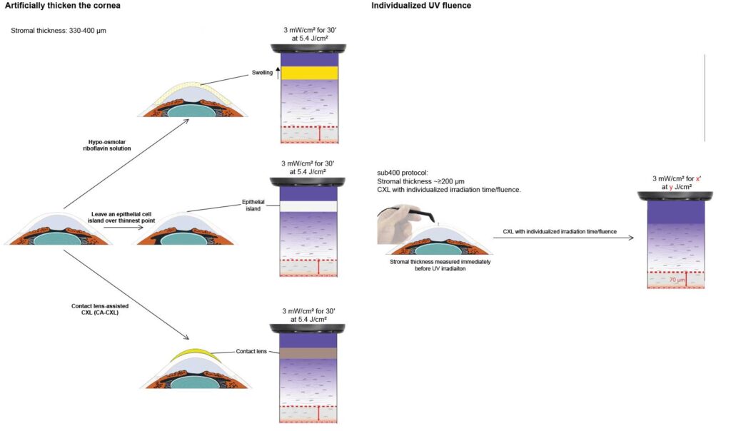 ELZA-sub400 protocol compared with other thin cornea CXL protocols