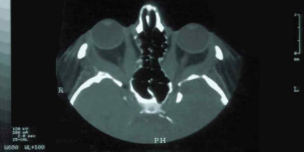Bulging Eyes Graves Disease Surgery